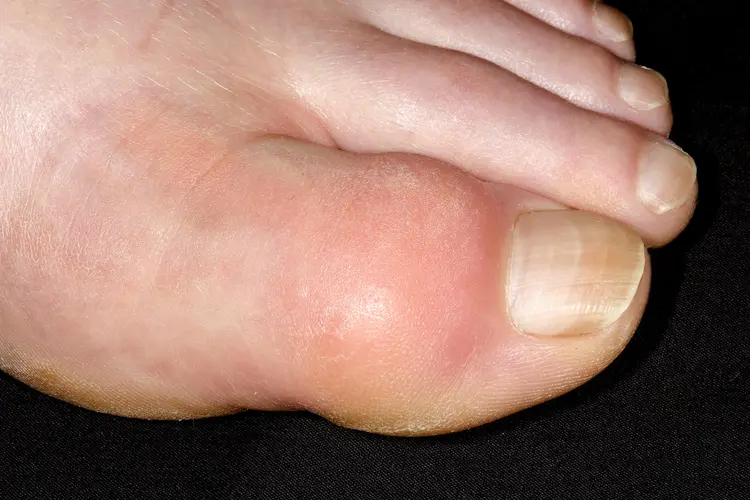 Metabolic Disorders