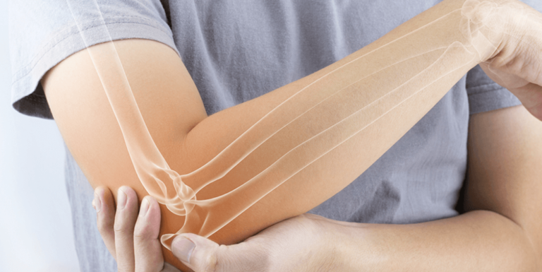 Arthritis