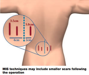 Smaller Scars