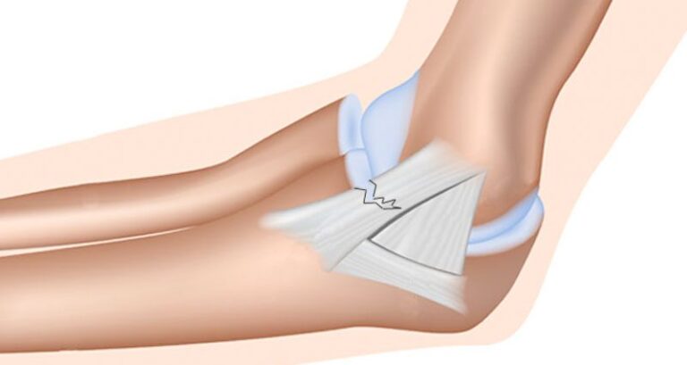 Ligament Sprains/Tears